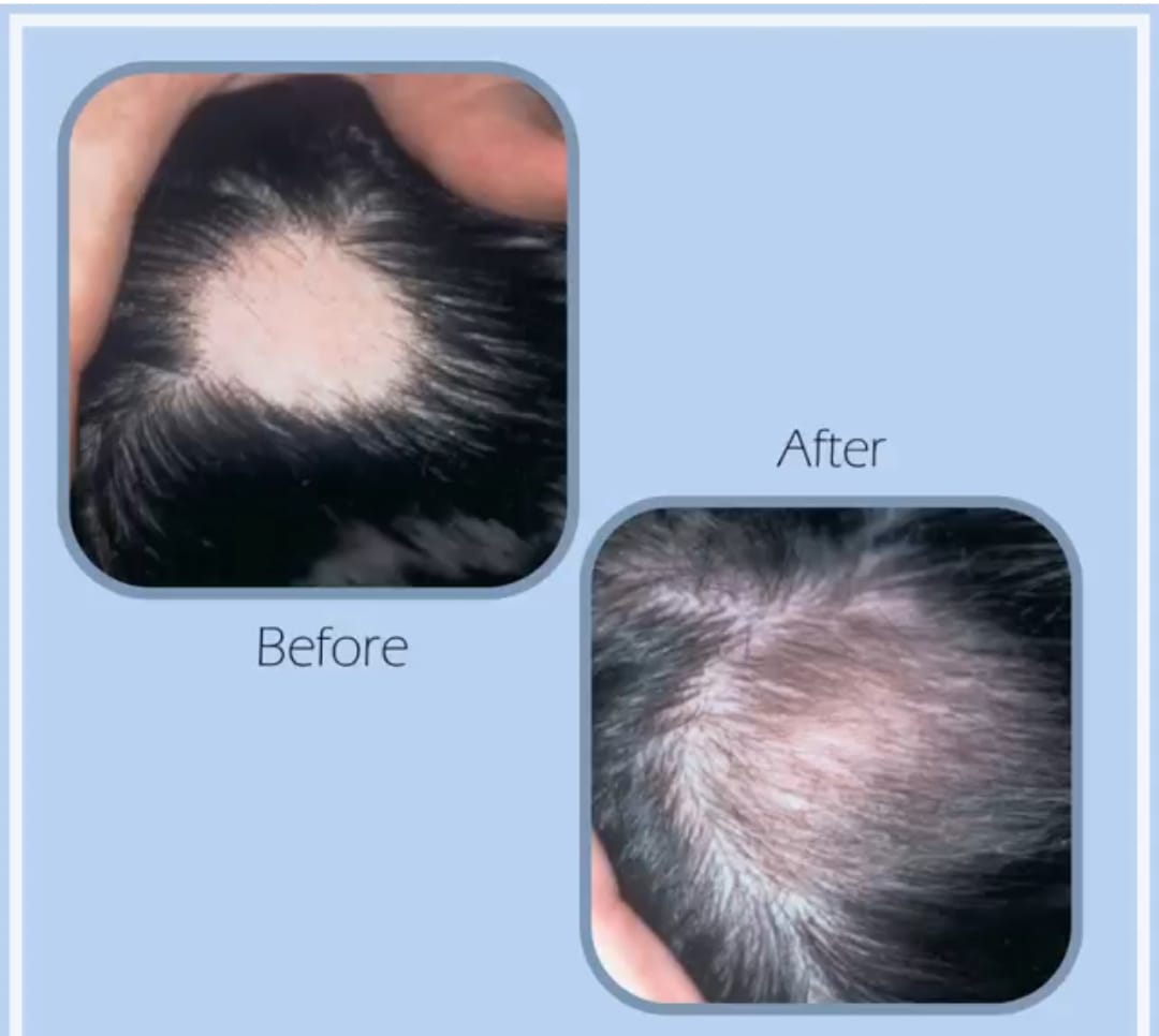 Spitalul Clinic CF Timisoara / Trateaza gratuit pacientii care sufera de alopecia areata