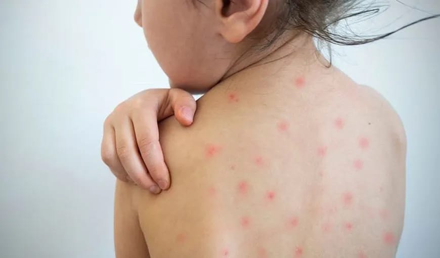 In judetul Hunedoara / Epidemie de rujeola