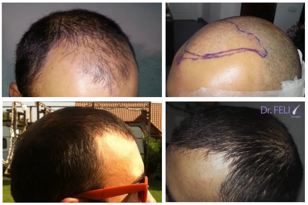La Dr. Felix Hair Implant transplantul de par este efectuat prin tehnica Q-FUE 