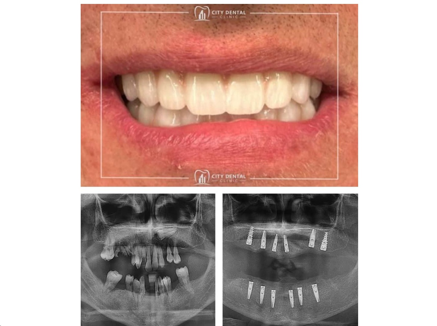 Implant dentar fara durere